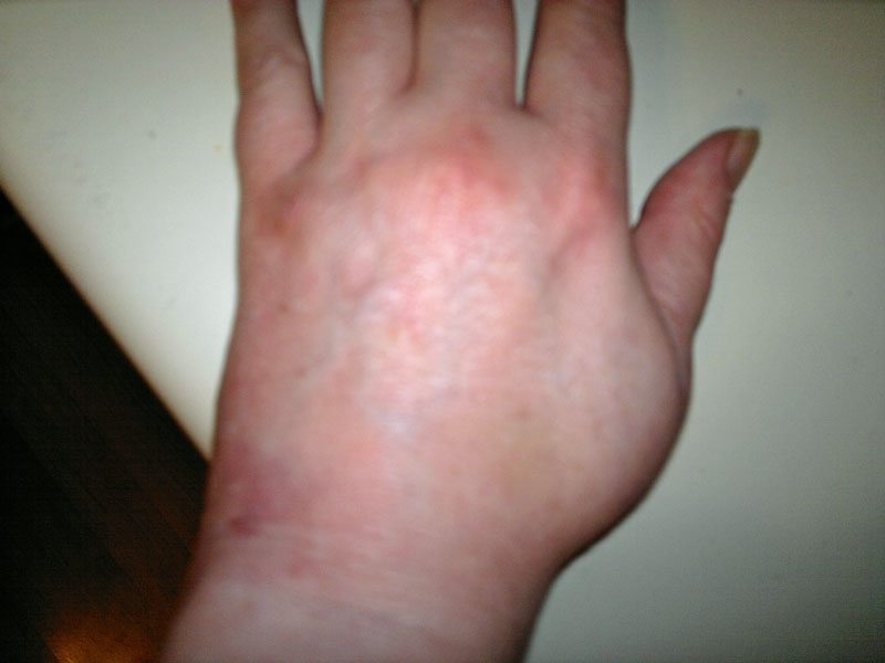  torn thumb ligament and torn outer wrist ligament