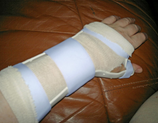 Wrist and Thumb Spica Splint